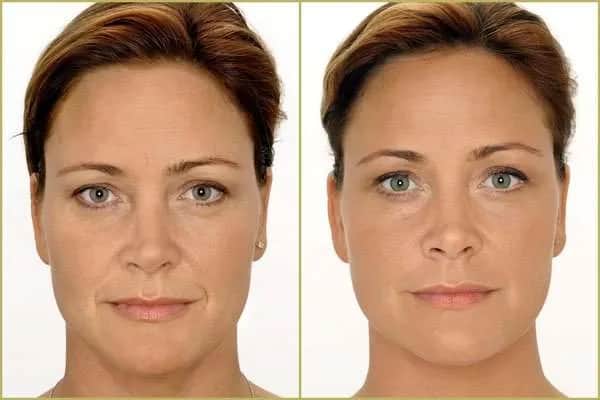 Gdzie wstrzykuje się kwas hialuronowy? Odkryj najlepsze miejsca i efekty