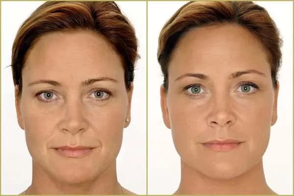 Gdzie wstrzykuje się kwas hialuronowy? Odkryj najlepsze miejsca i efekty