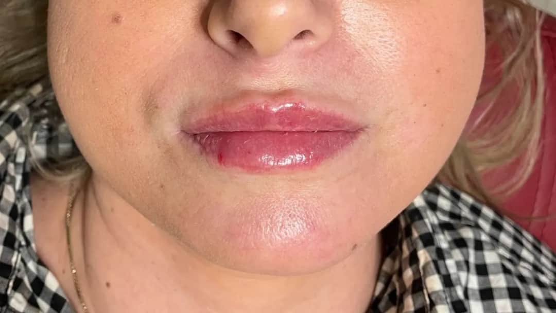 Jak zlikwidować siniaki po kwasie hialuronowym: skuteczne metody i porady