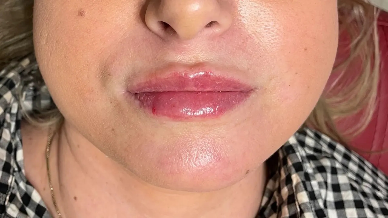 Jak zlikwidować siniaki po kwasie hialuronowym: skuteczne metody i porady