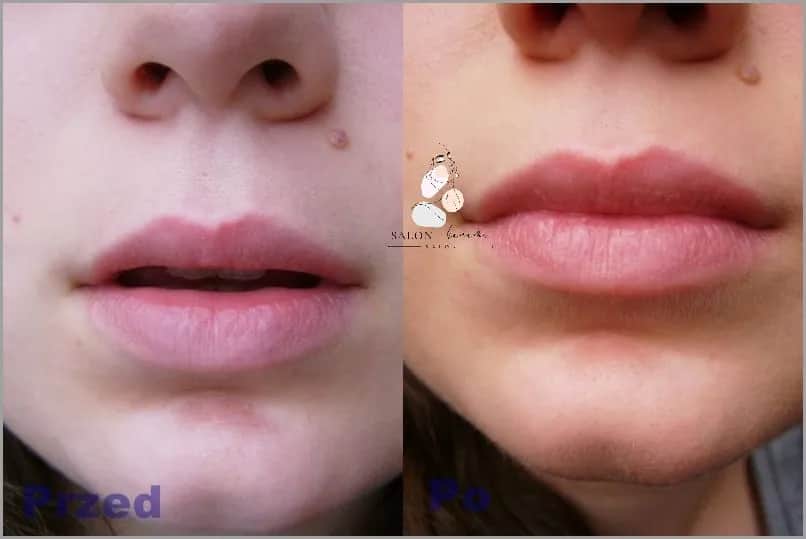 Kiedy schodzi opuchlizna po kwasie hialuronowym? Poznaj prawdę o czasie regeneracji